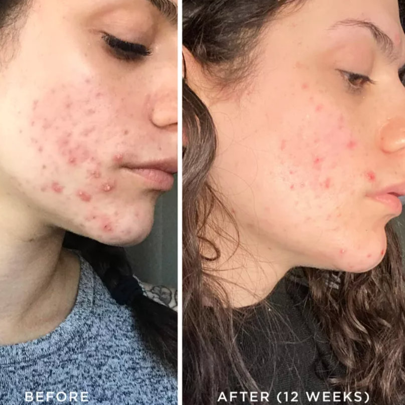 Cru Organic Facial + Seasonal Peel + High Frequency