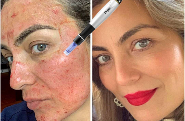 Microneedling Facial Buy One Get One Free