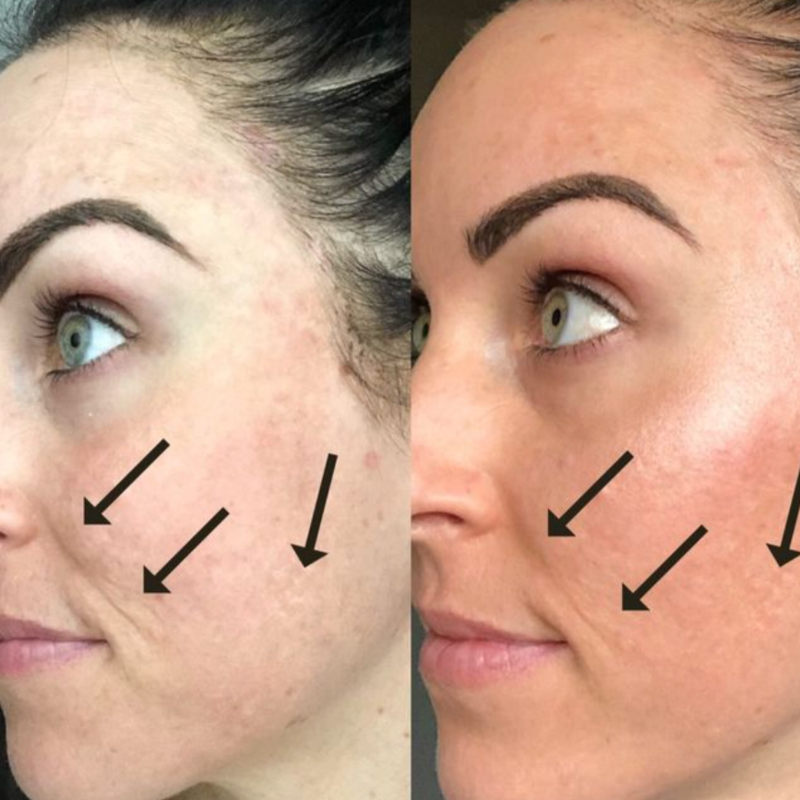 Microneedling Facial Buy One Get One Free