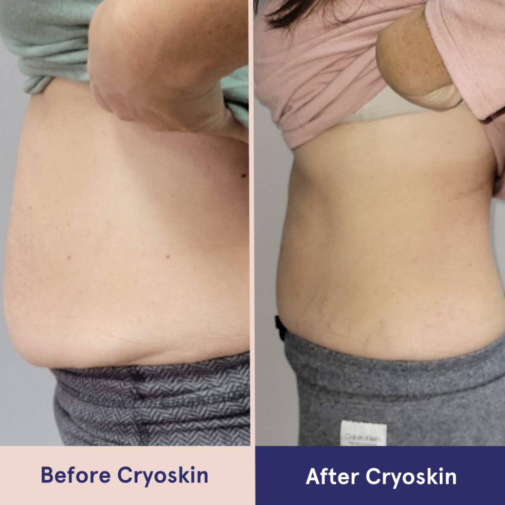 2 Cryoskin Slimming + Free Cryoskin Facial