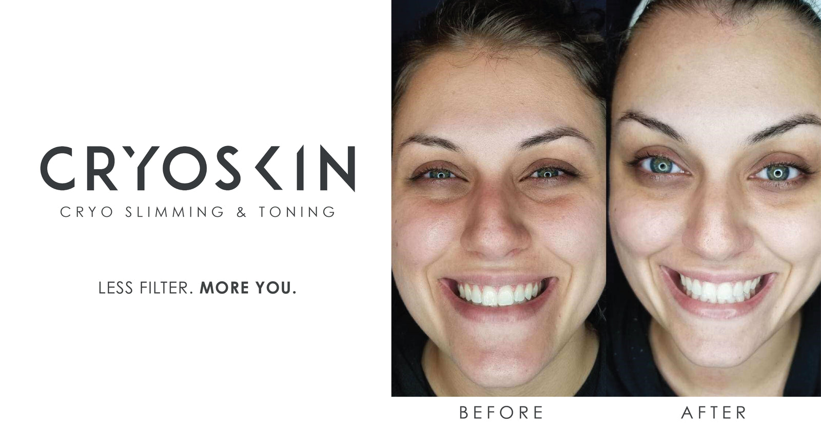 Cryoskin Face Lift
