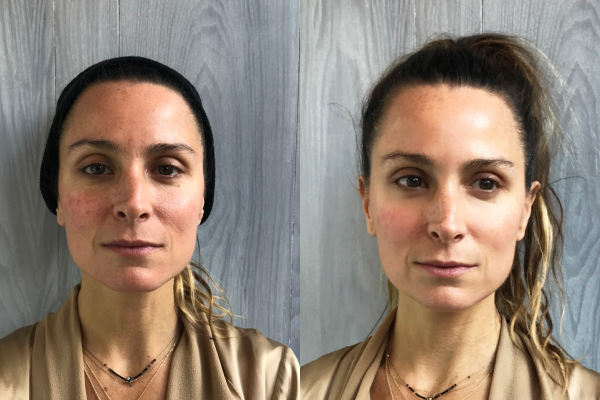 Cryoskin Face Lift