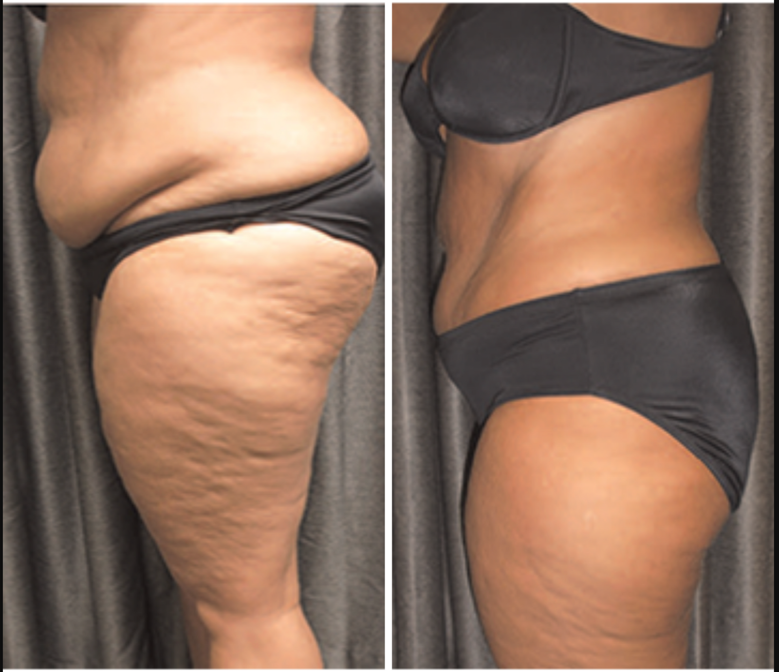 Emerald Laser Models Needed Edition