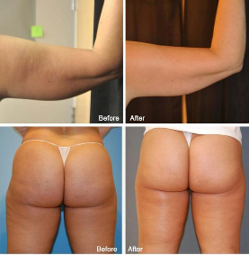 Cru Sculpt Treatment