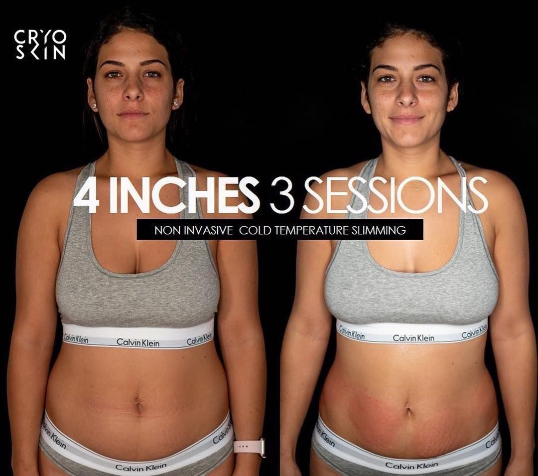 2 Cryoskin Slimming + Free Cryoskin Facial