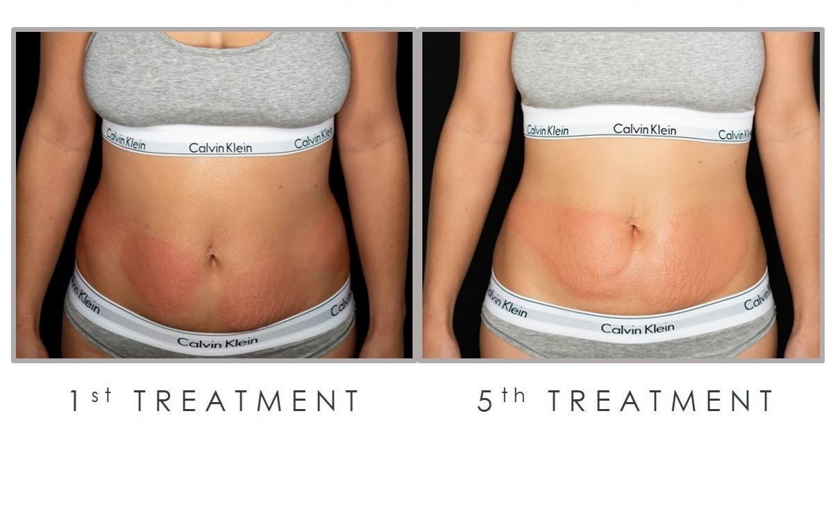 Why Cryoskin Triumphs Over Tummy Tucks: The Revolutionary Path to Body Contouring