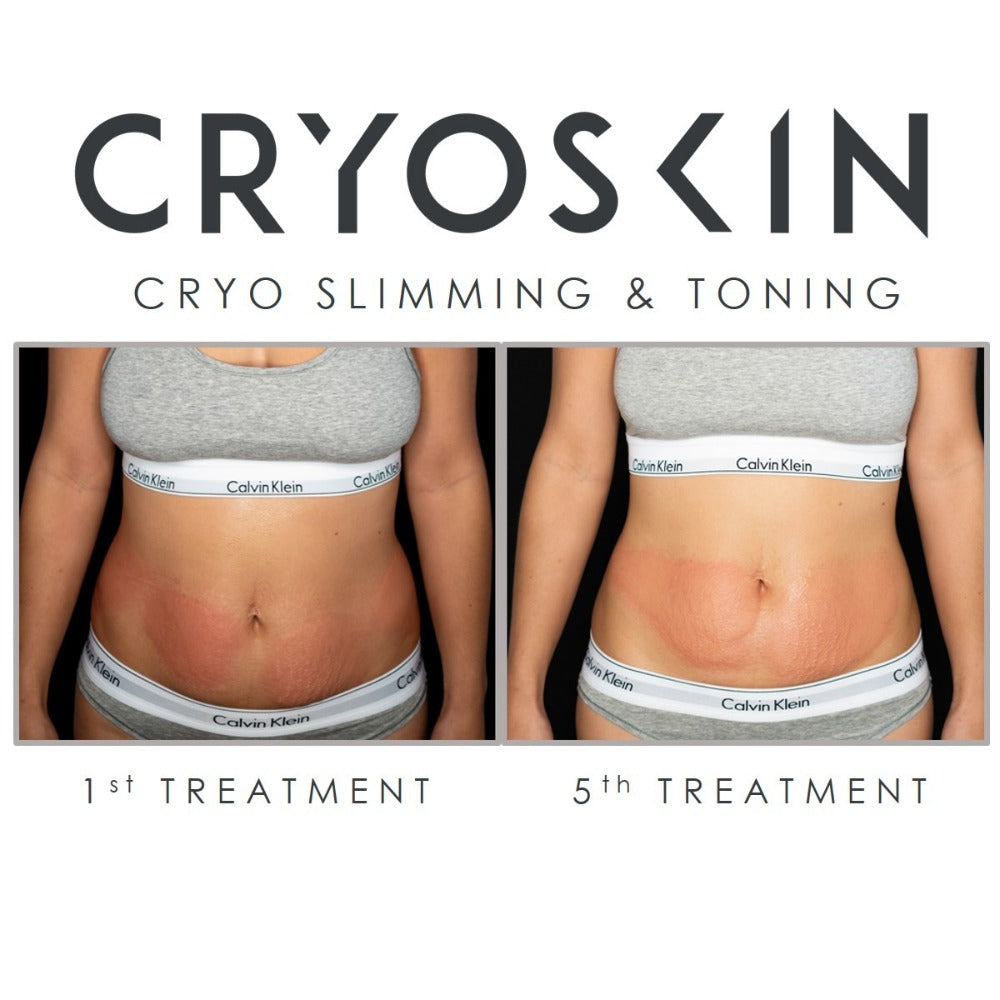 6 Emerald Laser + 6 Cryoskin