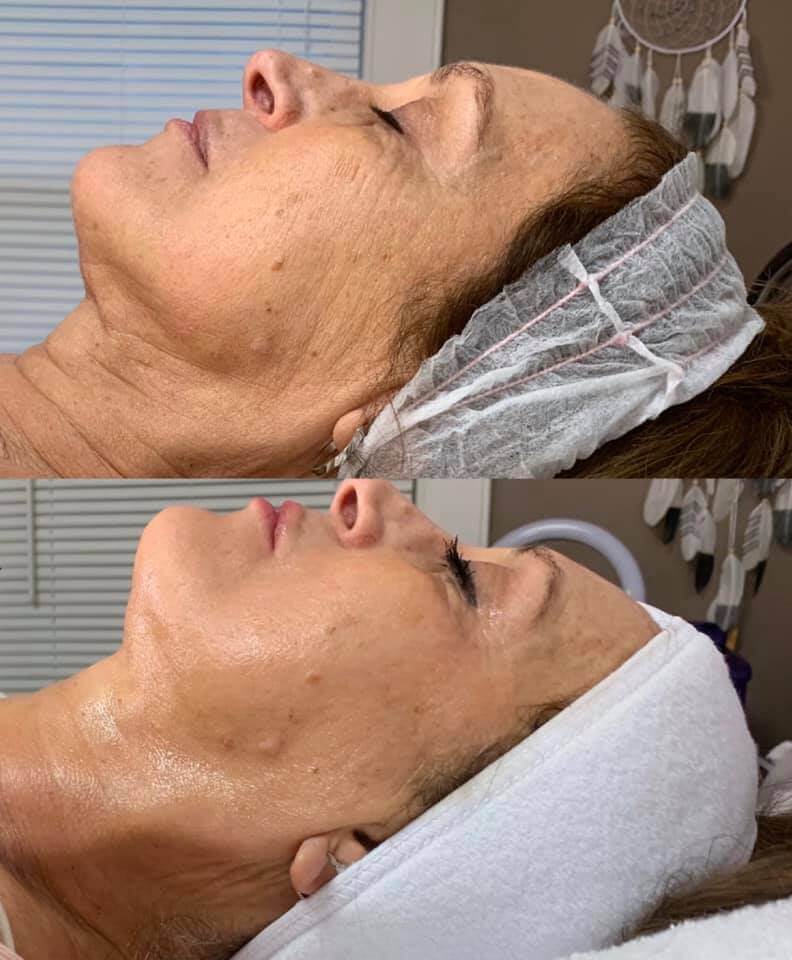 Cryoskin Facial Event Deposit