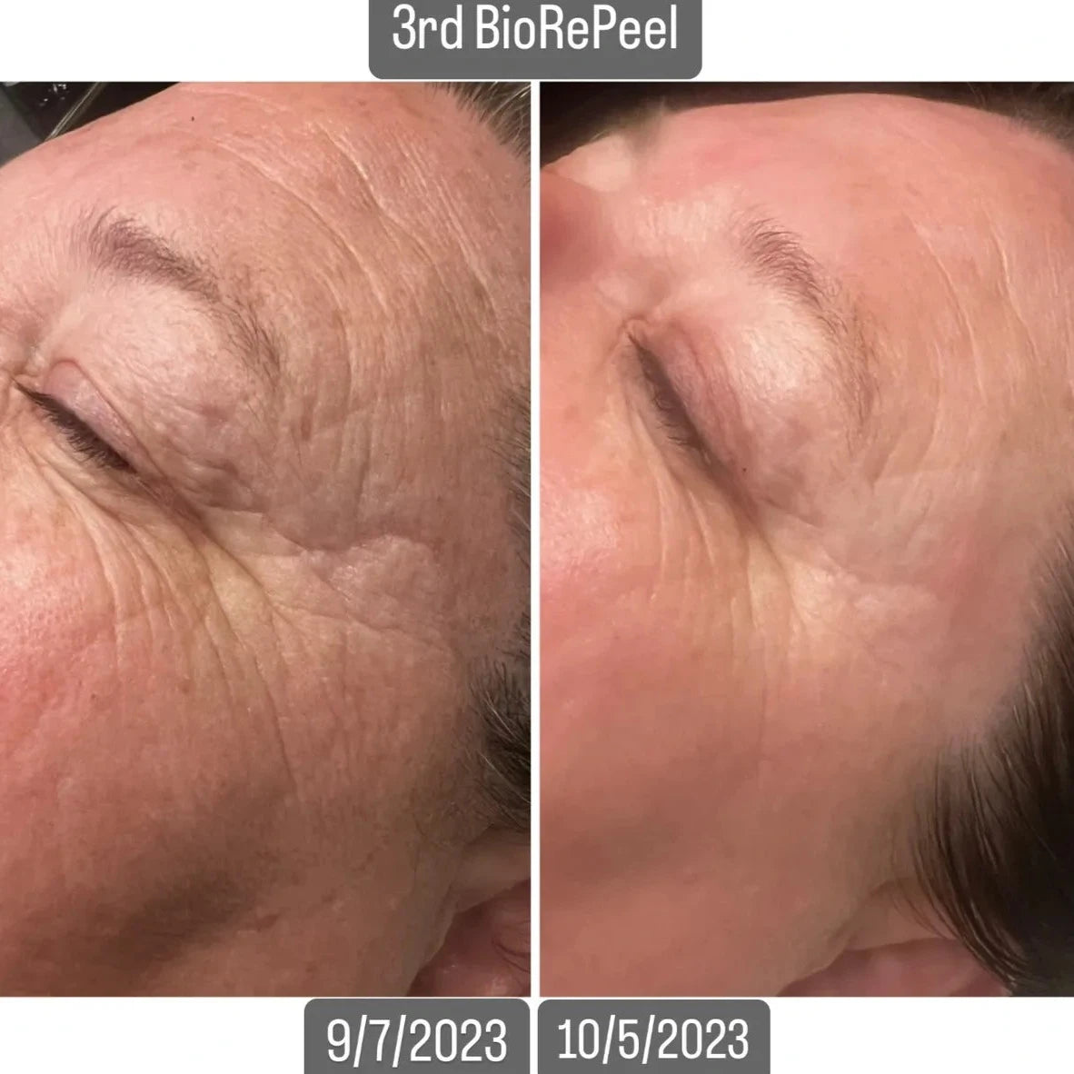 BioRe Peel