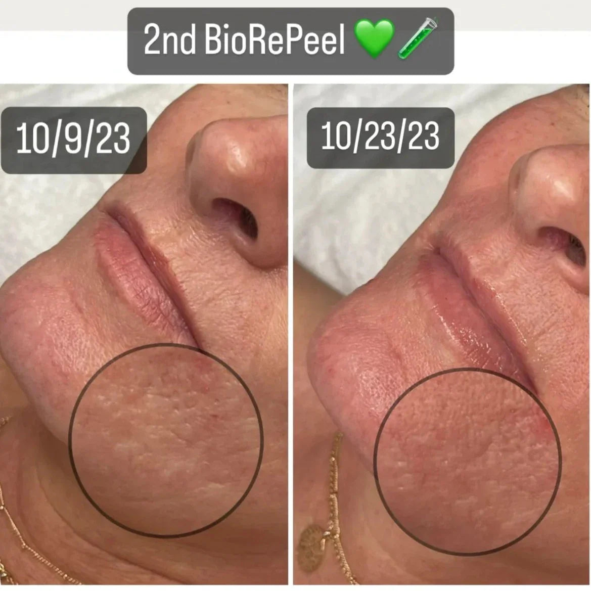 BioRe Peel Peel Party Deposit