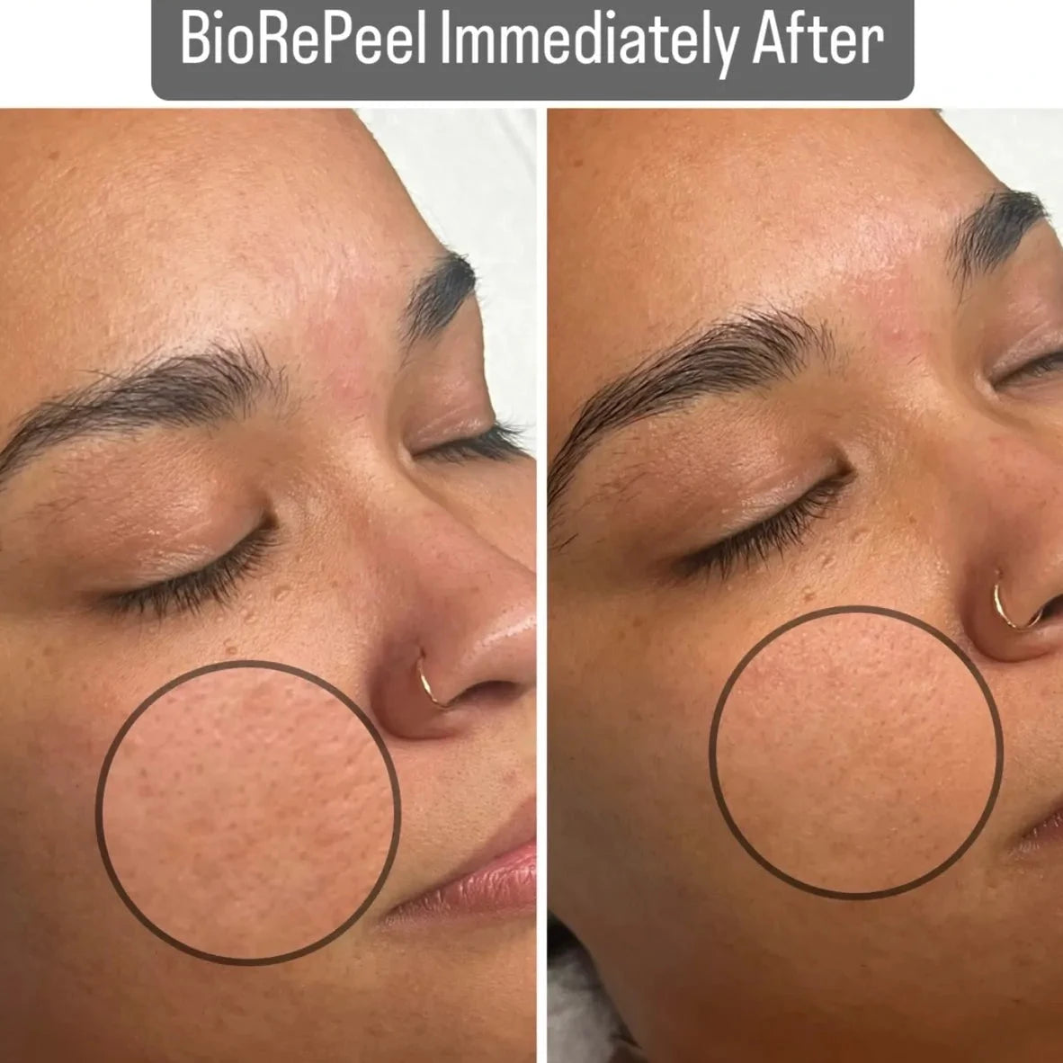 Microneedling Facial + BioRe Peel Bundle