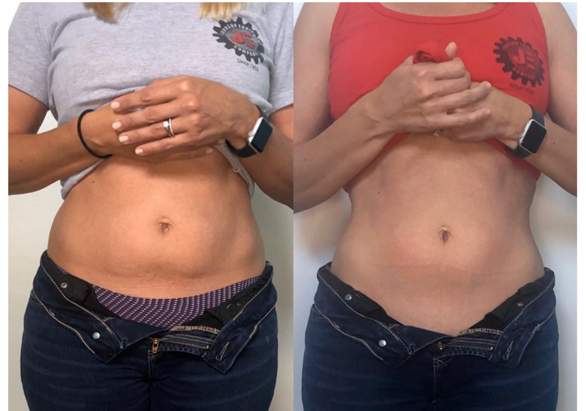 Cell Therapy  Session +Cryoskin Slimming Session