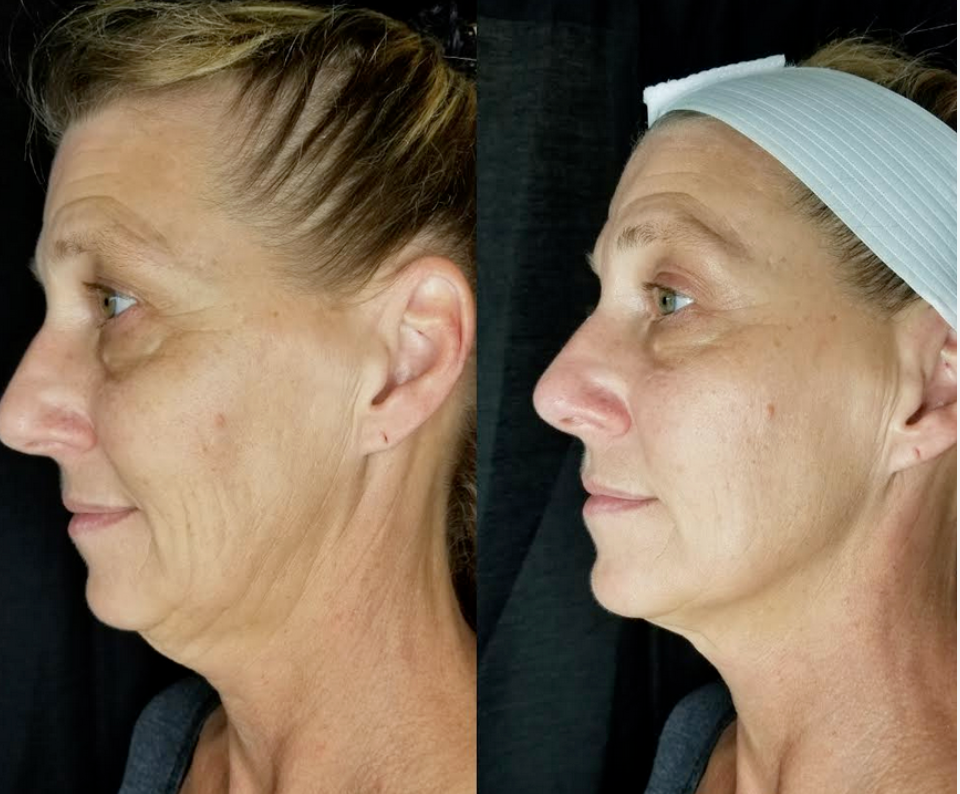 2 Cryoskin Facials + Cryoskin Slimming Treatment