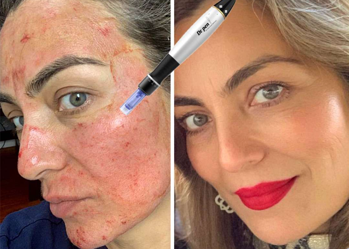 Duo Dermaplaning Facial &amp; Microneedling Facial