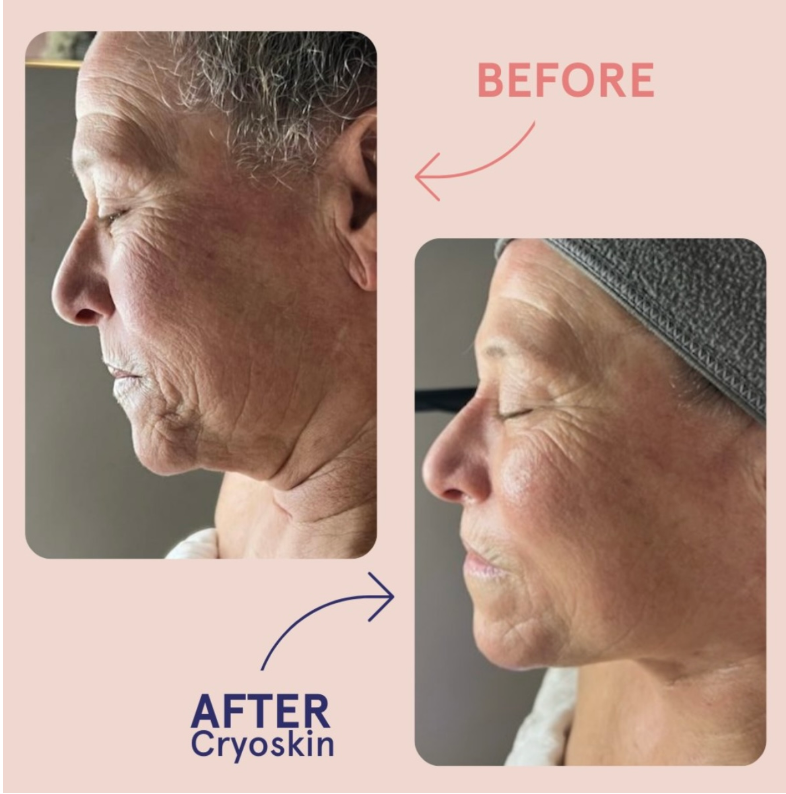 Cryoskin Face Lift Facial 10 Series