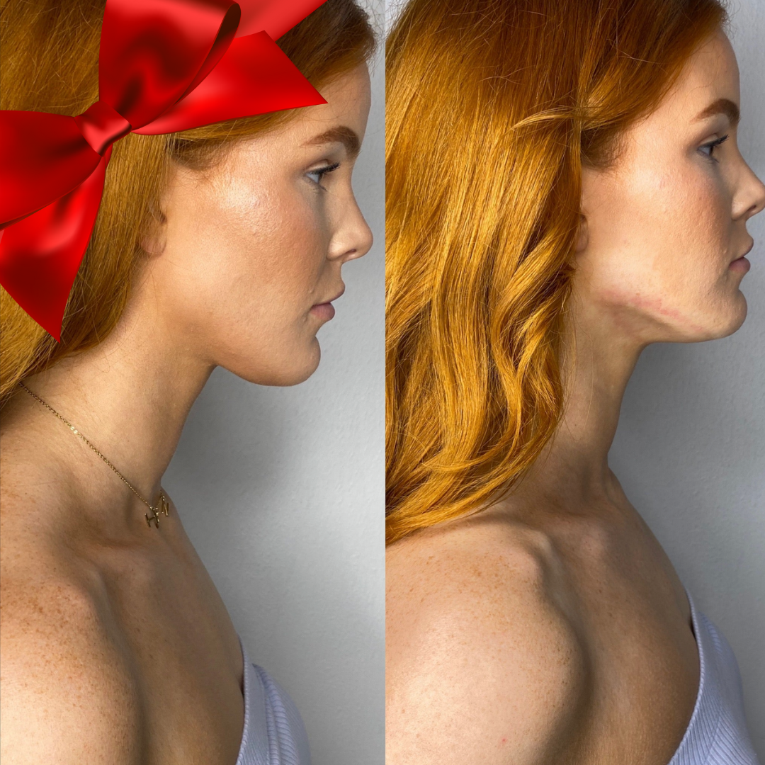 Cryoskin Chin &amp; Jaw Sculpt Buy 2 Get 1 Free