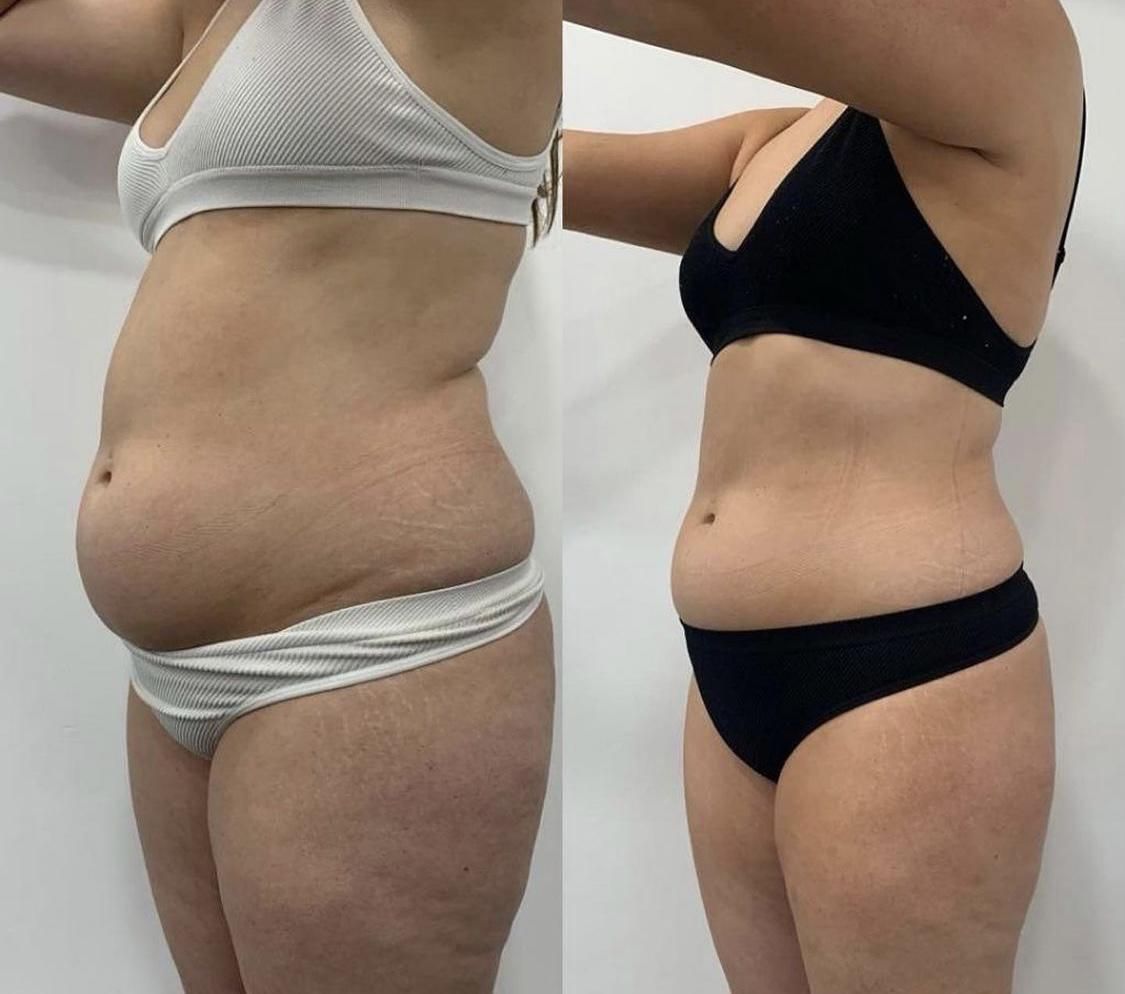 10 Body Contouring Sessions + Get 2 Free