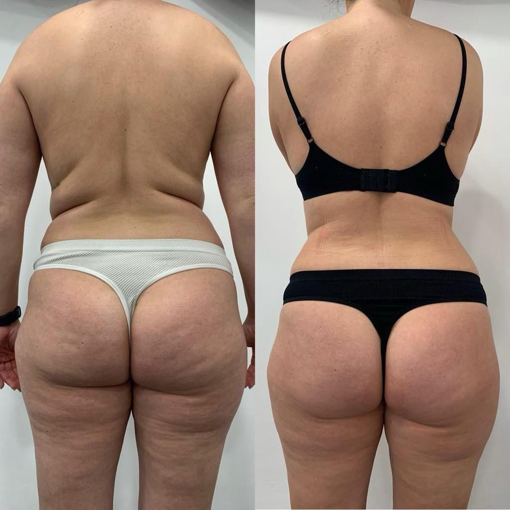 10 Body Contouring Sessions + Get 2 Free