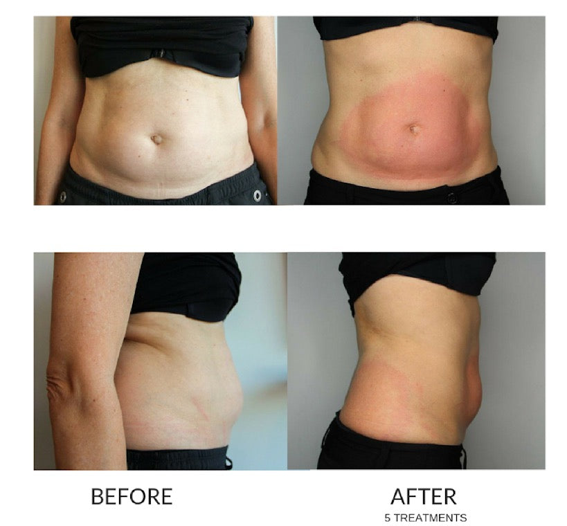 Cryoskin Slimming 5 Series + Cell Therapy 3 Series