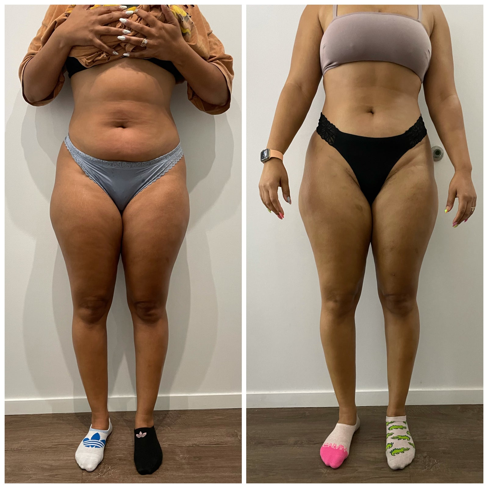 Cell Therapy  Session +Cryoskin Slimming Session