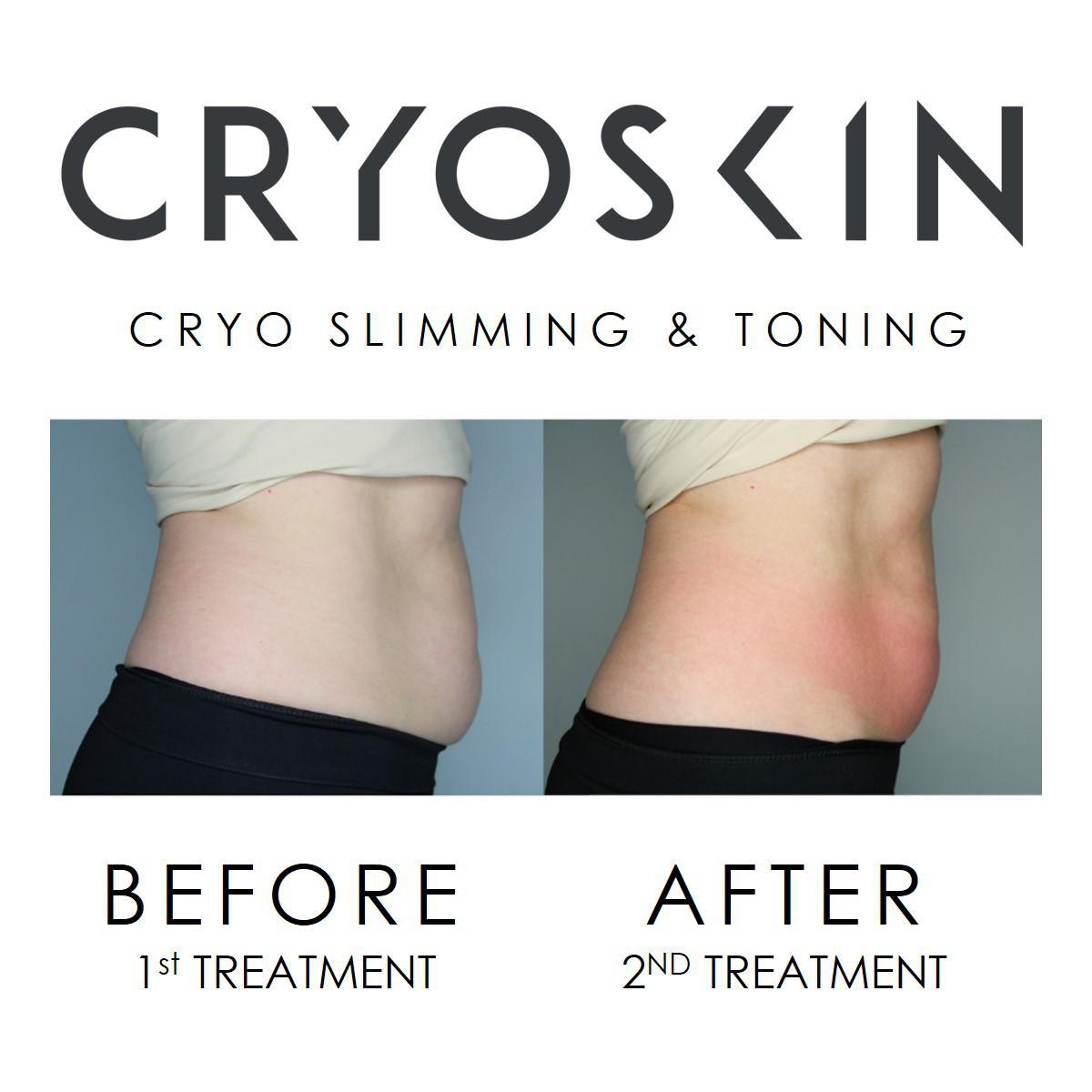 Cryoskin 5 Slimming Series