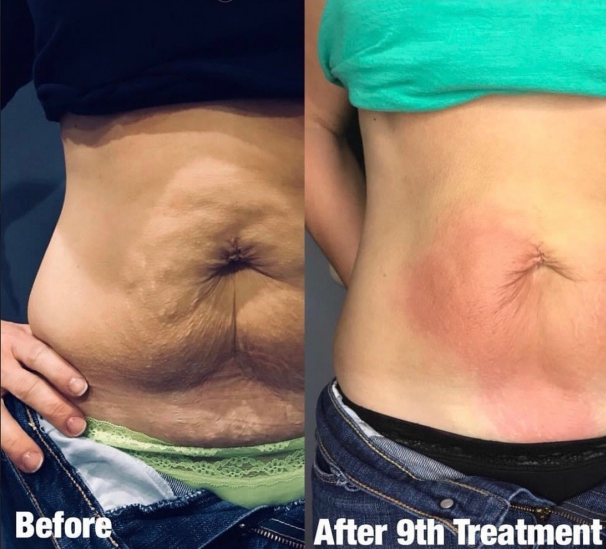 10 Body Contouring Sessions + Get 2 Free