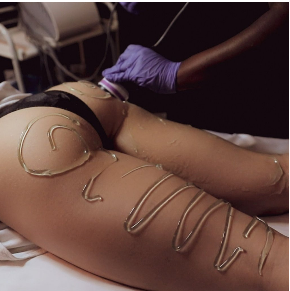 Cru Sculpt Treatment