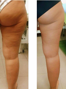 Cru Sculpt Treatment