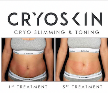 Cryoskin Slimming
