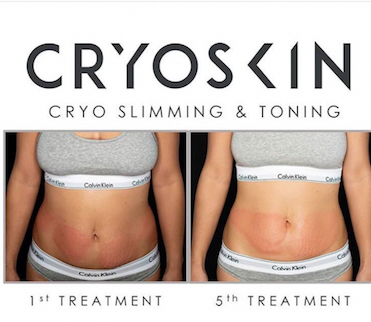 8 Cryoskin Slimming Treatments